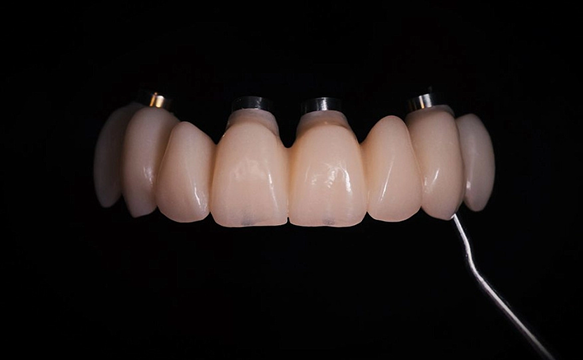 Кейс: временный протез на мультиюнитах